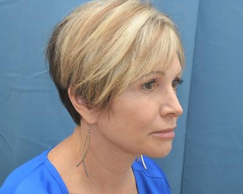Facelift Before & After Gallery - Patient 120377442 - Image 4