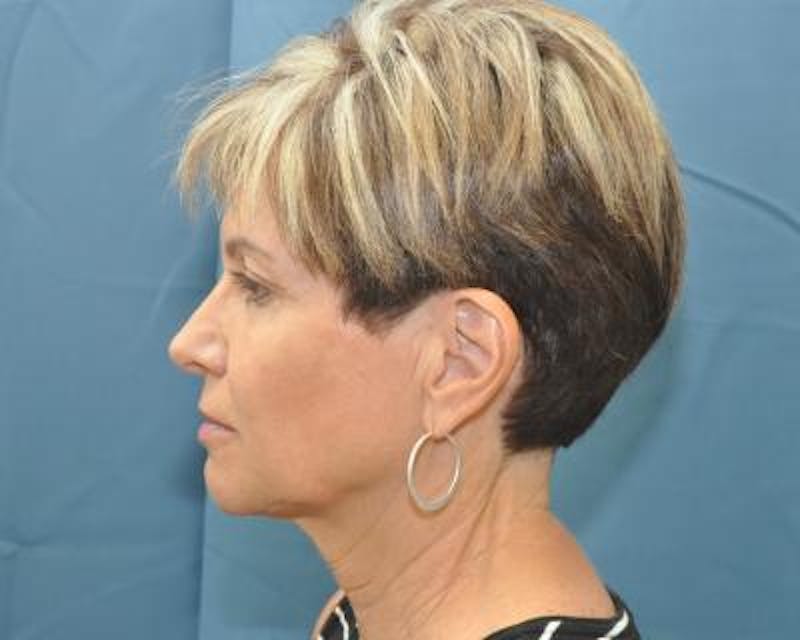 Necklift Before & After Gallery - Patient 159263381 - Image 5