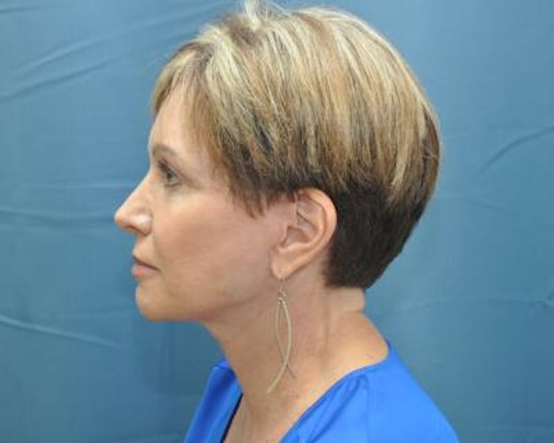 Necklift Before & After Gallery - Patient 159263381 - Image 6