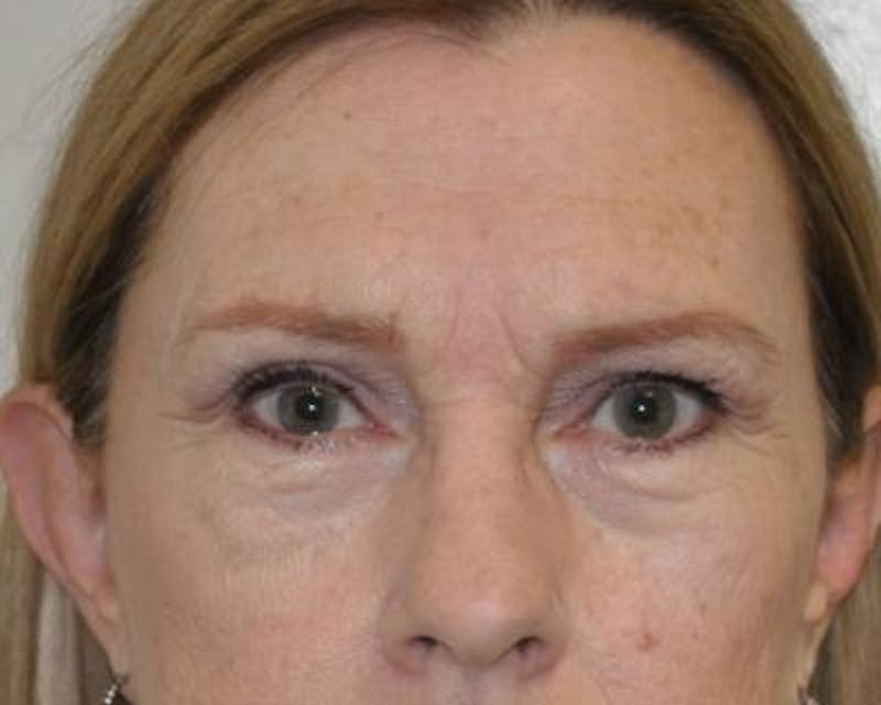 Blepharoplasty Before & After Gallery - Patient 120377443 - Image 1