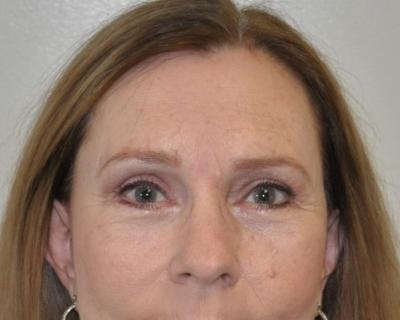 Blepharoplasty Before & After Gallery - Patient 120377443 - Image 2