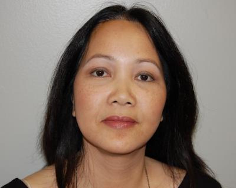 Blepharoplasty Before & After Gallery - Patient 120377448 - Image 2