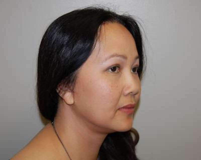 Blepharoplasty Before & After Gallery - Patient 120377448 - Image 4