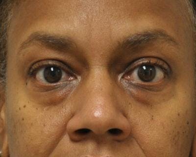 Blepharoplasty Before & After Gallery - Patient 120377450 - Image 1
