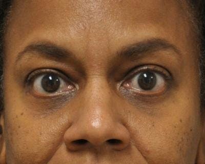 Blepharoplasty Before & After Gallery - Patient 120377450 - Image 2