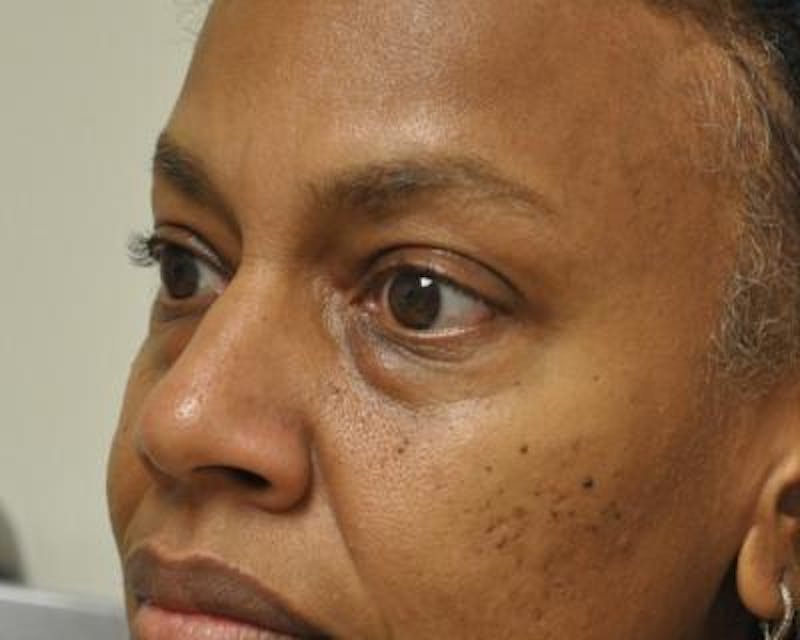 Blepharoplasty Before & After Gallery - Patient 120377450 - Image 3