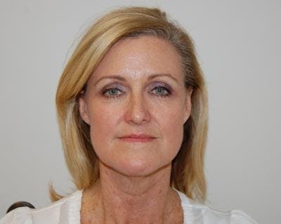 Facelift Before & After Gallery - Patient 120377451 - Image 1