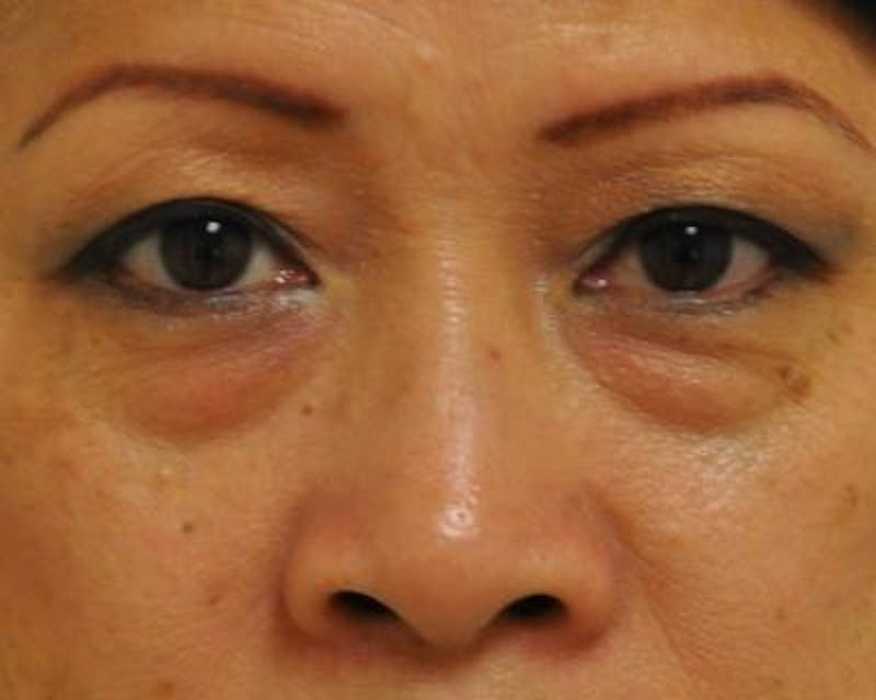 Blepharoplasty Before & After Gallery - Patient 120377452 - Image 1