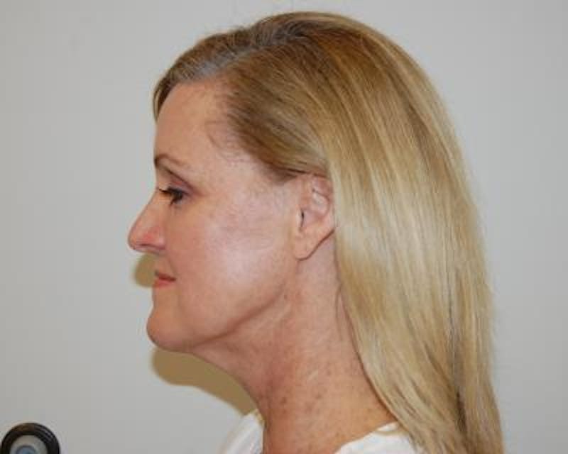 Necklift Before & After Gallery - Patient 159263384 - Image 3