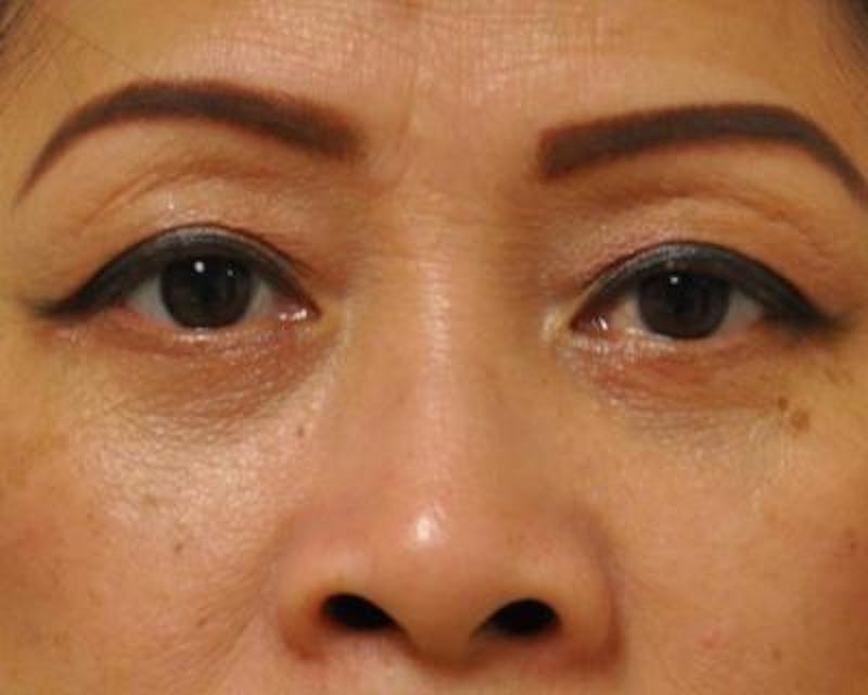 Blepharoplasty Before & After Gallery - Patient 120377452 - Image 2