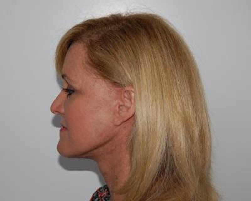 Facelift Before & After Gallery - Patient 120377451 - Image 4