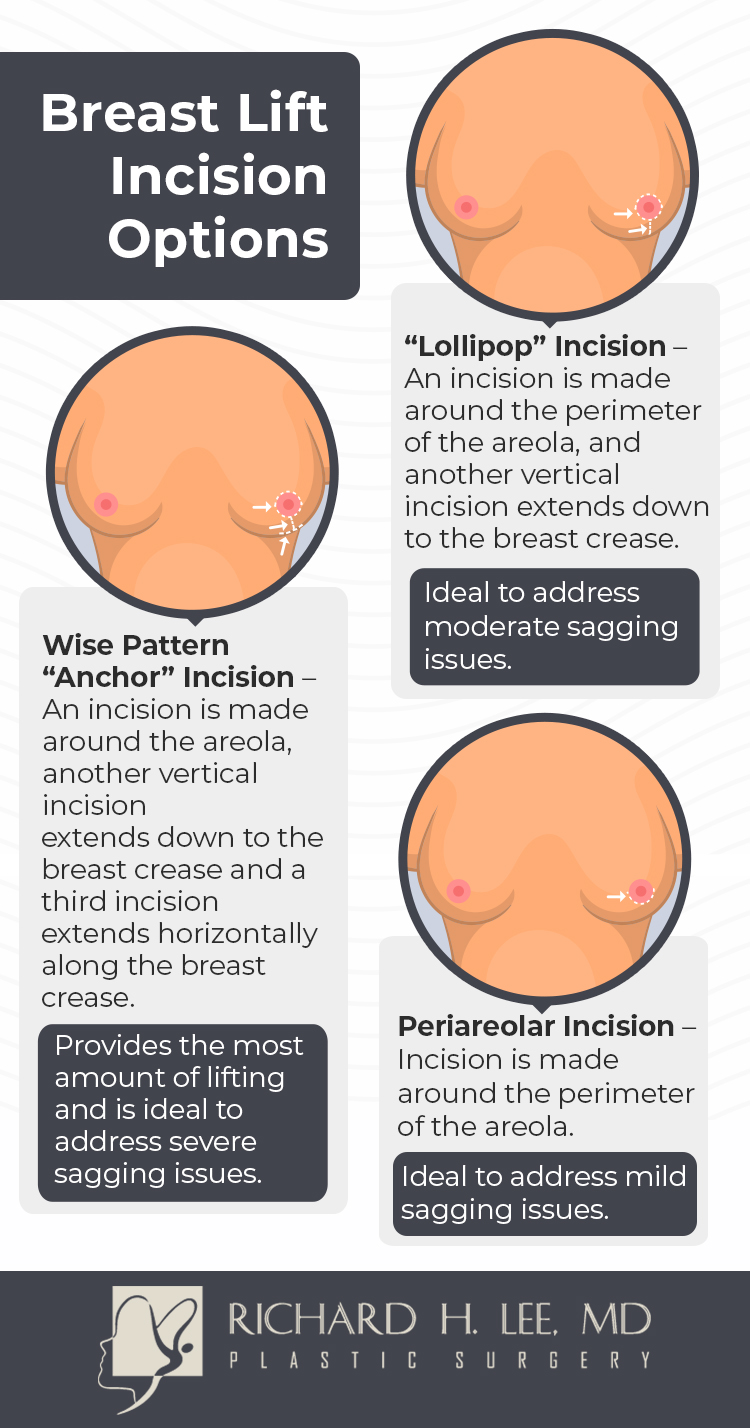 Types Of Breast Lift Incisions  Chicago Breast & Body Aesthetics