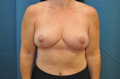 Breast Implant Removal Before & After Gallery - Patient 121357149 - Image 2