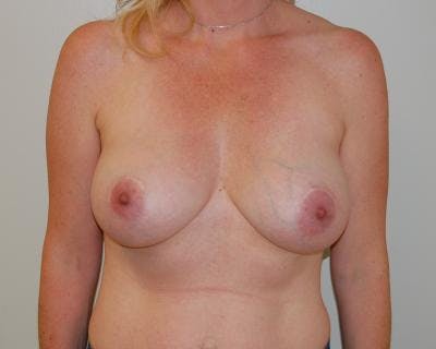 Breast Implant Removal Before & After Gallery - Patient 121357285 - Image 1