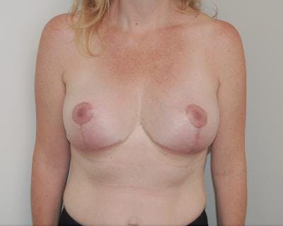 Breast Implant Removal Before & After Gallery - Patient 121357285 - Image 2