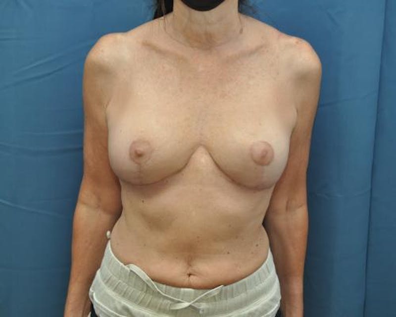 Breast Implant Removal Before & After Gallery - Patient 121357286 - Image 2