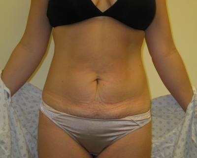 Tummy Tuck Before & After Gallery - Patient 120350062 - Image 1