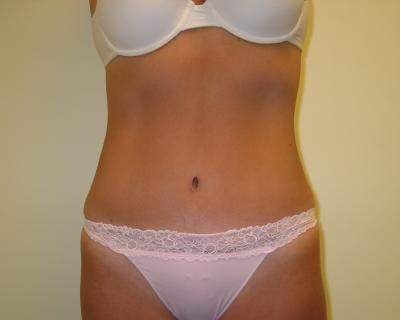 Tummy Tuck Before & After Gallery - Patient 120350062 - Image 2