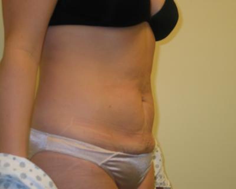 Tummy Tuck Before & After Gallery - Patient 120350062 - Image 3