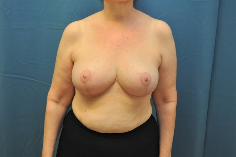 Breast Reduction Before & After Gallery - Patient 121639245 - Image 2