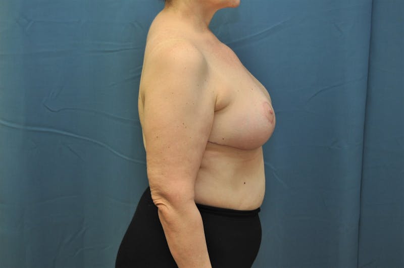 Breast Reduction Gallery - Patient 121639245 - Image 6