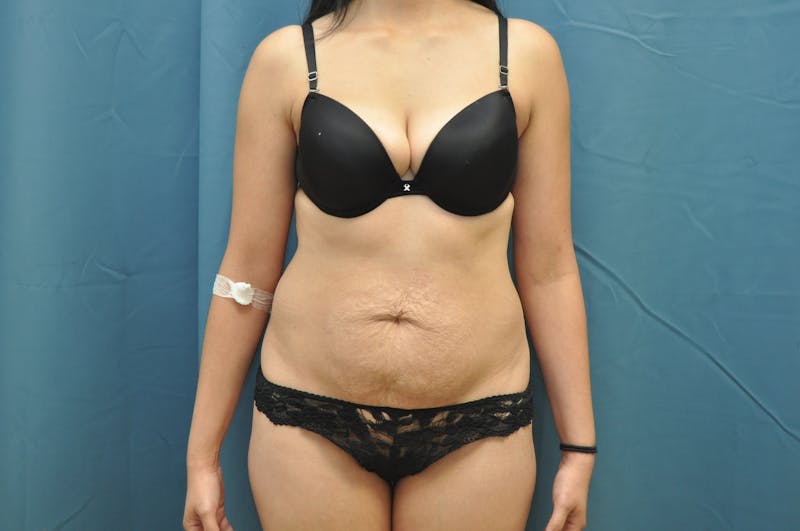 Tummy Tuck Before & After Gallery - Patient 121639252 - Image 1