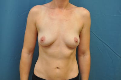 Breast Augmentation Before & After Gallery - Patient 122610969 - Image 1