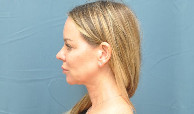 Facelift Before & After Gallery - Patient 122878091 - Image 5