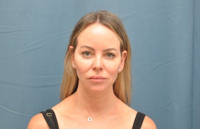Facelift Before & After Gallery - Patient 122878091 - Image 1