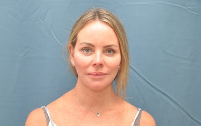 Facelift Before & After Gallery - Patient 122878091 - Image 2