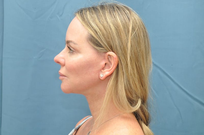 Facelift Before & After Gallery - Patient 122878091 - Image 6