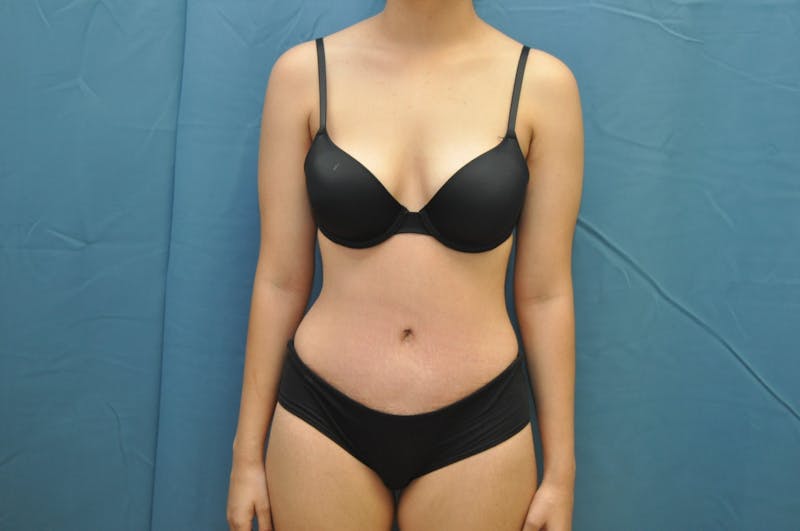 Tummy Tuck Before & After Gallery - Patient 122999156 - Image 2