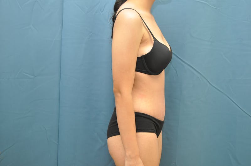Tummy Tuck Before & After Gallery - Patient 122999156 - Image 6