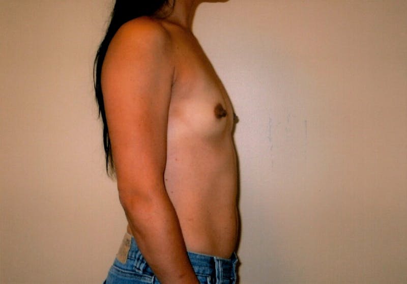Breast Augmentation Before & After Gallery - Patient 143035066 - Image 3