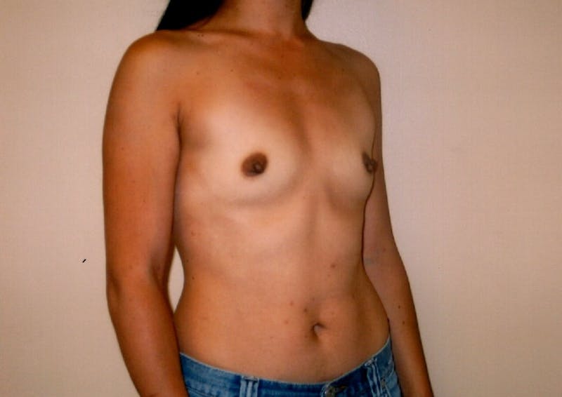 Breast Augmentation Before & After Gallery - Patient 143035066 - Image 5