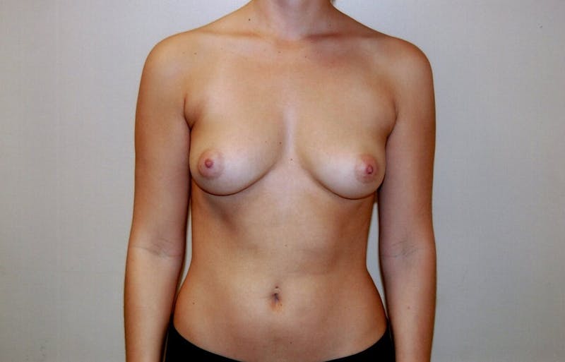 Breast Augmentation Before & After Gallery - Patient 143035061 - Image 1