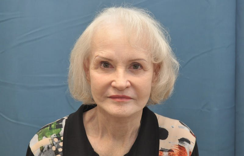 Facelift Before & After Gallery - Patient 144611047 - Image 2