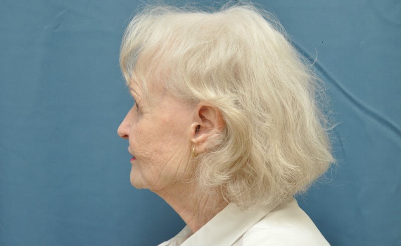 Necklift Before & After Gallery - Patient 159263386 - Image 5