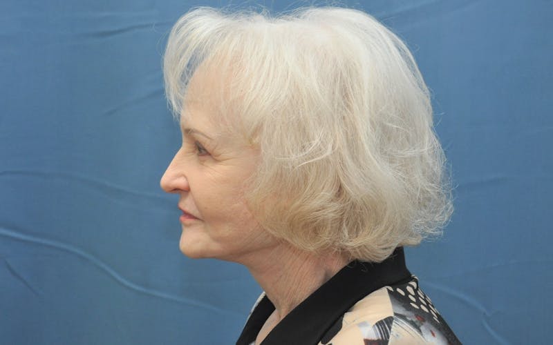 Facelift Before & After Gallery - Patient 144611047 - Image 6