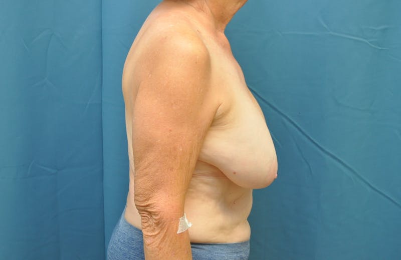 Breast Reduction Before & After Gallery - Patient 144611566 - Image 5