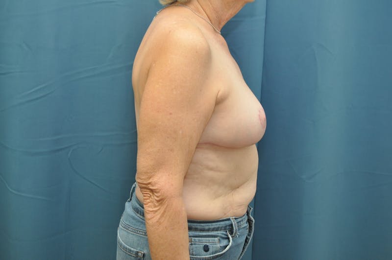 Breast Reduction Before & After Gallery - Patient 144611566 - Image 6