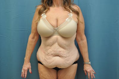 Tummy Tuck Before & After Gallery - Patient 146207585 - Image 1
