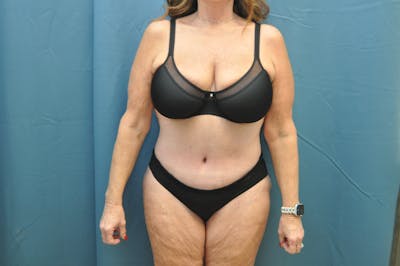 Tummy Tuck Before & After Gallery - Patient 146207585 - Image 2