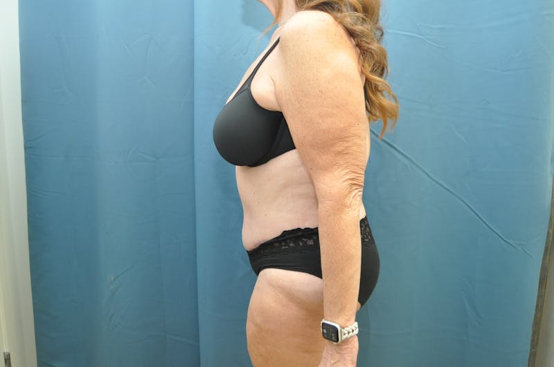 Tummy Tuck Before & After Gallery - Patient 146207585 - Image 6