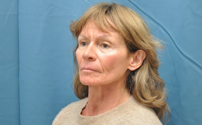 Facelift Before & After Gallery - Patient 146363302 - Image 3