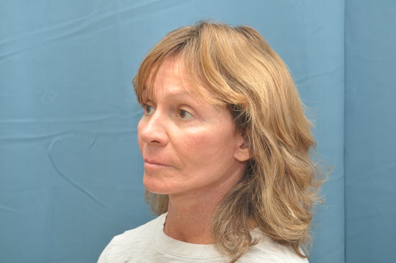 Facelift Before & After Gallery - Patient 146363302 - Image 4