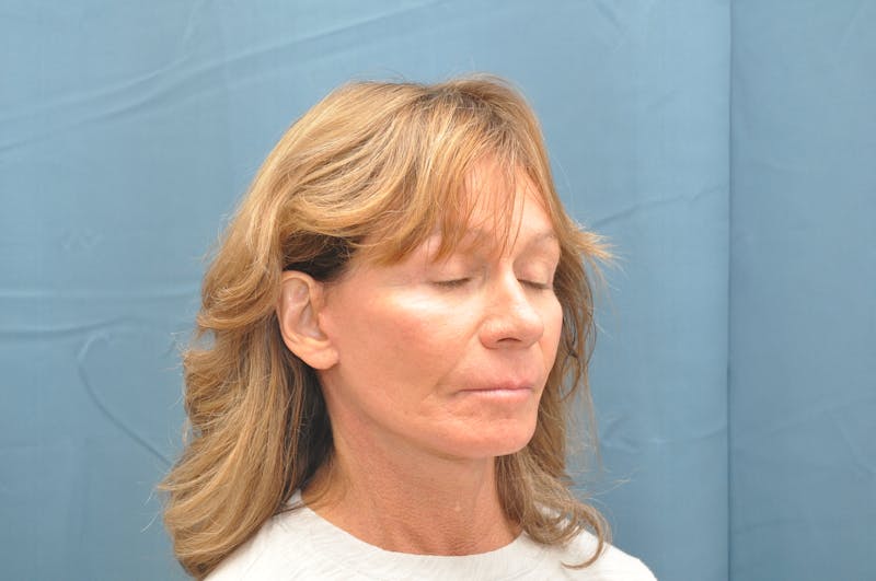 Facelift Before & After Gallery - Patient 146363302 - Image 6