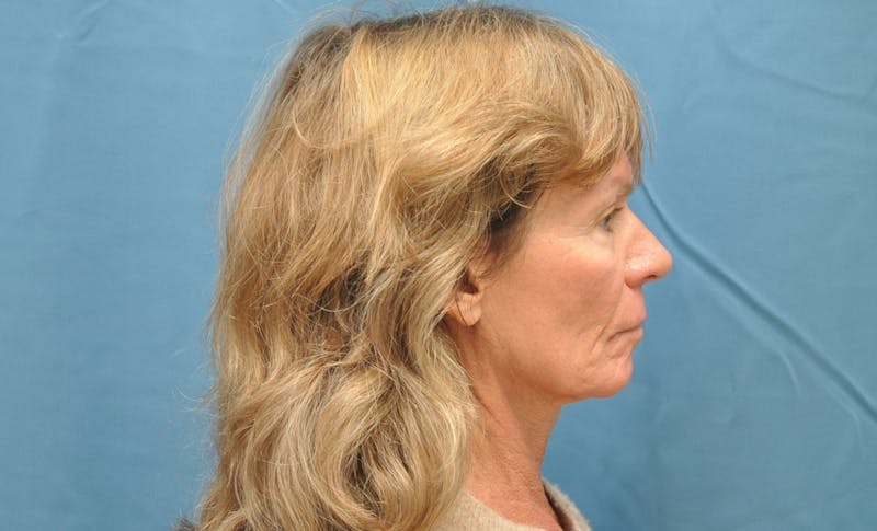 Necklift Before & After Gallery - Patient 159263387 - Image 7