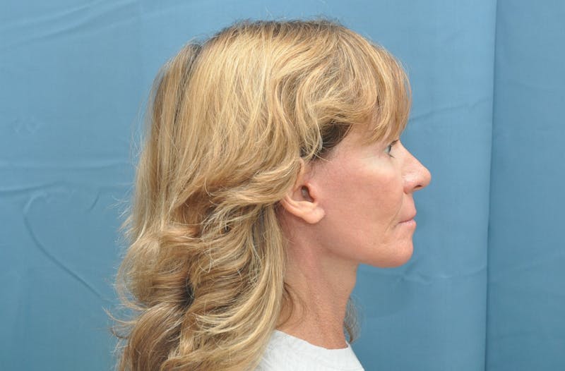 Necklift Before & After Gallery - Patient 159263387 - Image 8
