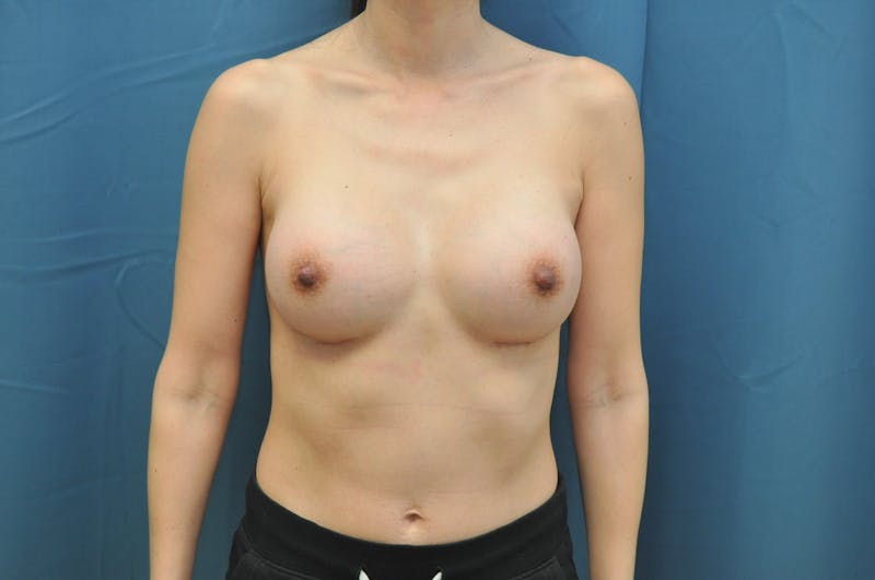 Breast Augmentation Before & After Gallery - Patient 147084470 - Image 2